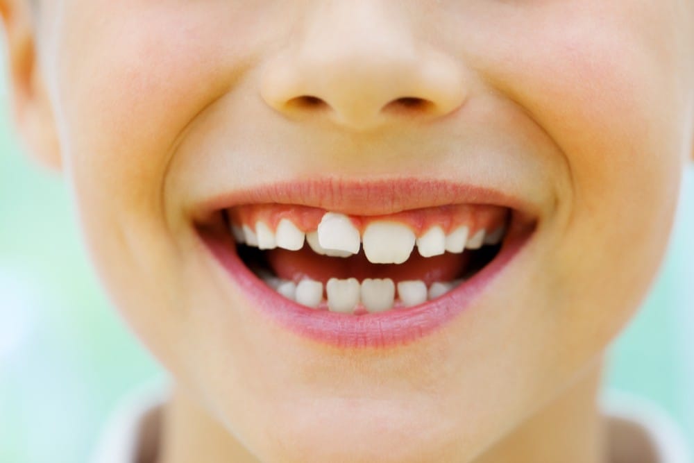 Common Causes Of Crooked Teeth In Children