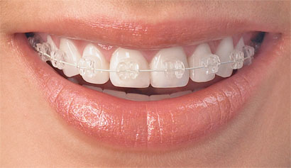clear-braces-v2_d496b9053061a563c4d544a2ec108624 clear-braces-v2_d496b9053061a563c4d544a2ec108624