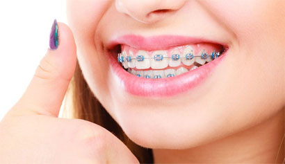 traditional-braces-v2_1aff201131d67bf6edf3182ae7beaa80 traditional-braces-v2_1aff201131d67bf6edf3182ae7beaa80