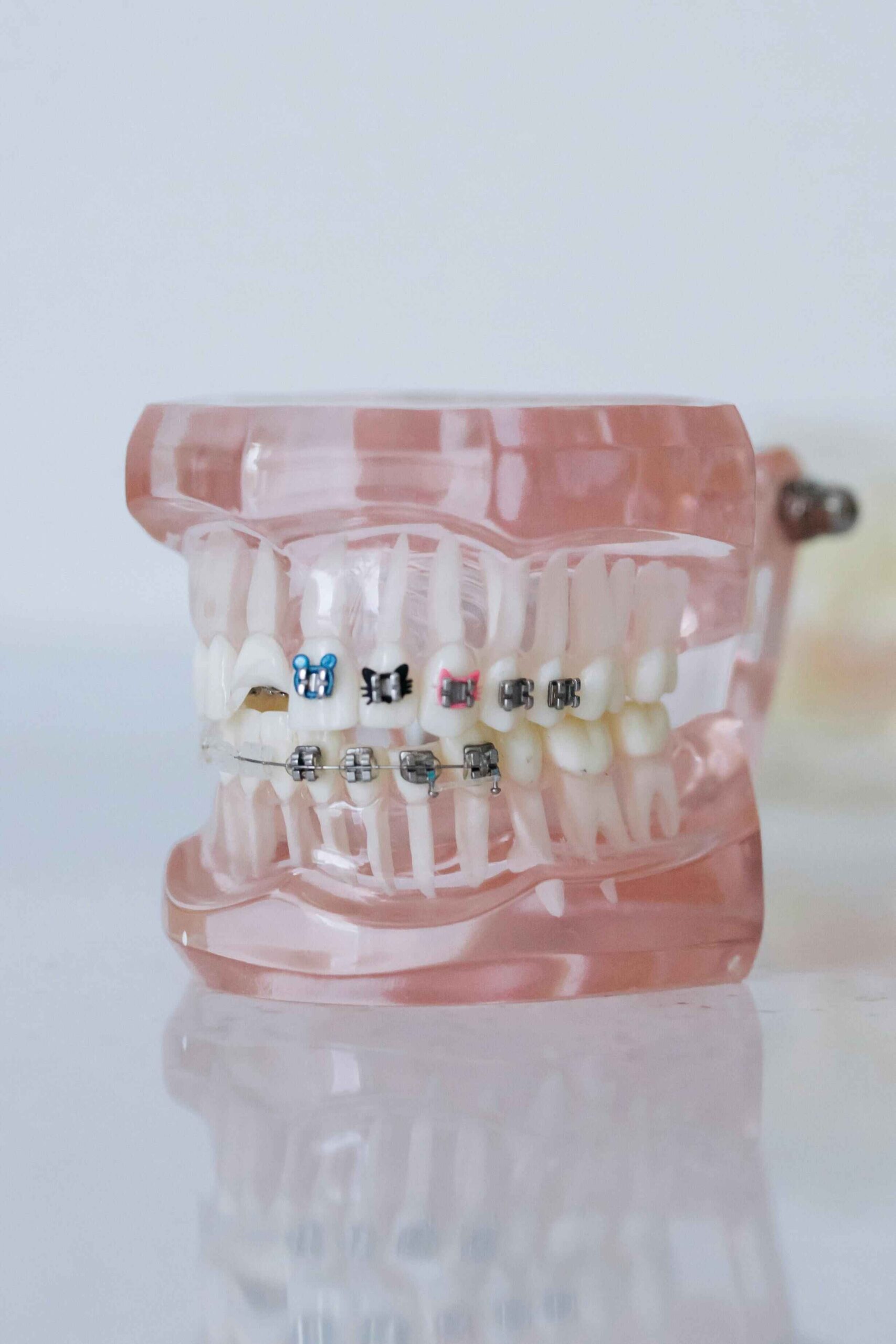 braces on teeth model