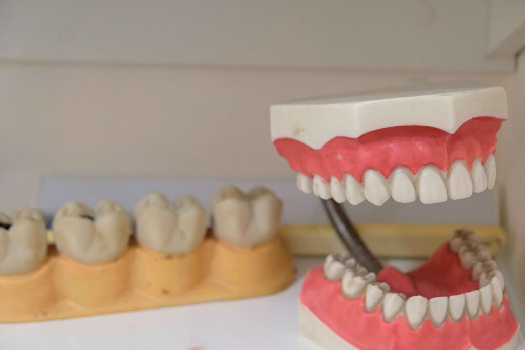 teeth model after cavities
