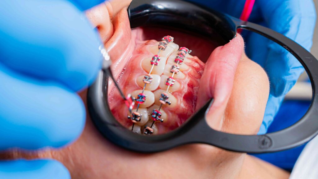 Guide to Choosing the Best Colors for Teeth Braces 1 patient getting colored braces